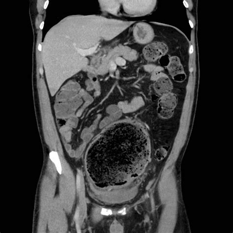 Severe Fecal Impaction With Stercoral Colitis Image Radiopaedia Org