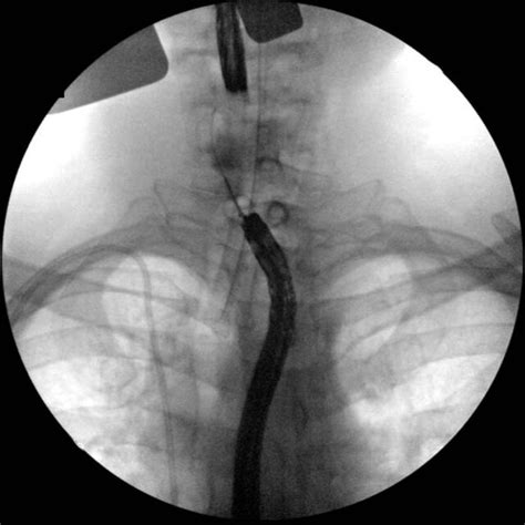 Fluoroscopy In The Right Anterior Oblique View Used To Confirm