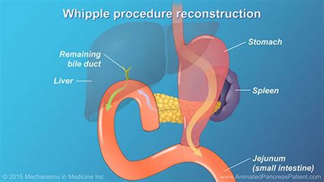 Whipple Procedure Animation