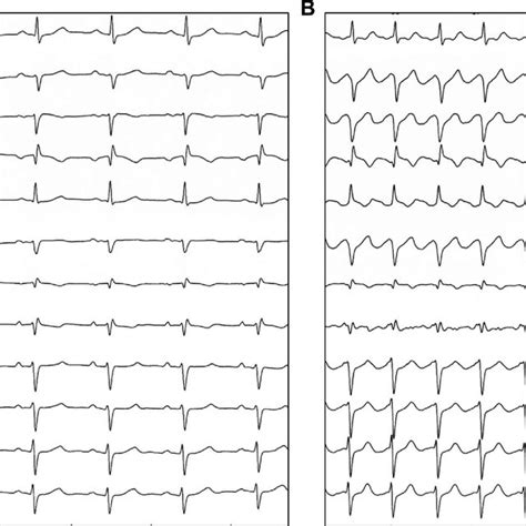 Twelve Lead Electrocardiogram Showing A A Sinus Rhythm After Left