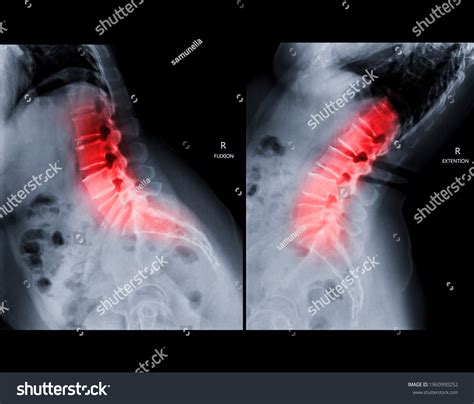 Lateral Lumbar Spine Xray