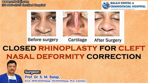 Revolutionizing Transformation Closed Rhinoplasty Unleashing Power For Cleft Nasal Deformity