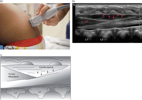 Lateral Recumbent Position Lumbar Puncture - Lumbar Puncture ...