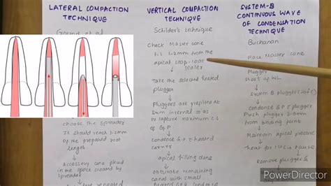Obturation Techniques In Endodontics Youtube