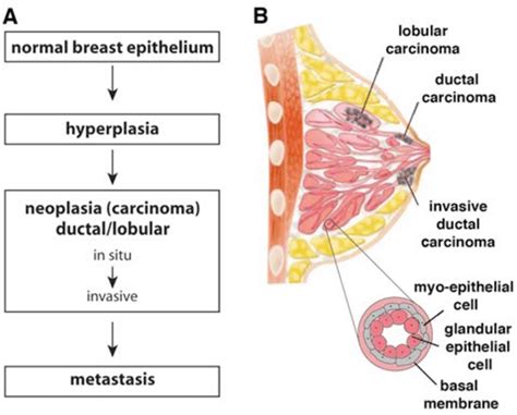 Breast Cancer Tumorigenesis A Scheme Of The Subsequent Steps Of