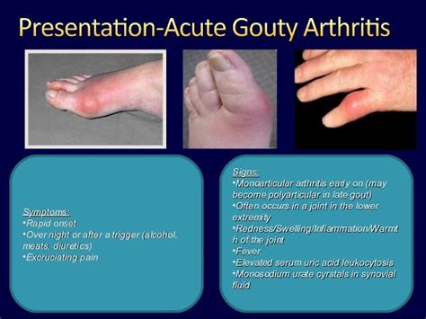 Signs and symptoms of chronic tophaceous gout - how to alleviate uric ...