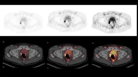 Estro Acrop Consensus Recommendation On The Target Volume Definition