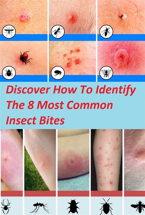 What Do Mosquito Bites Look Like After A Few Days At Joyce Krebs Blog