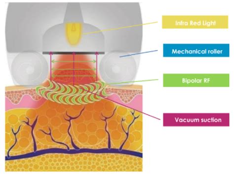 Slimming Cellulite Reduction In Hong Kong Nude Waxing