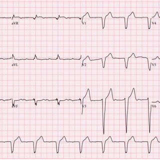 EKG Of The Patient Demonstrates Sinus Rhythm With 1st Degree AV Block