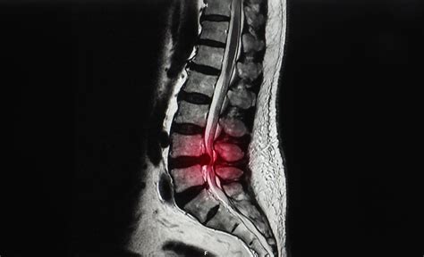Things To Avoid With Cervical Spinal Stenosis | Spine Specialists