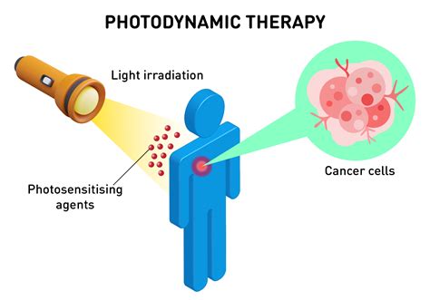 Is Photodynamic Therapy the “APT” of Cancer Research? - e-estidotmy