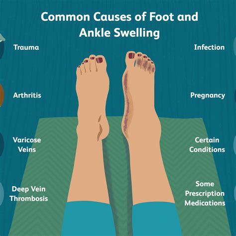 Exercises For Swollen Feet - Home Guide Guru