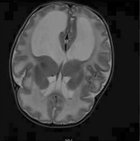B Mri Brain Of Patient Showing Bilateral Periventricular And