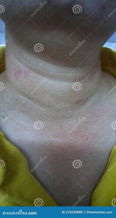 Redness At Neck Of Asian Woman Concept Of Sore Throat Pharyngitis