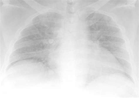 Interpreting A Chest X Ray Stepwards