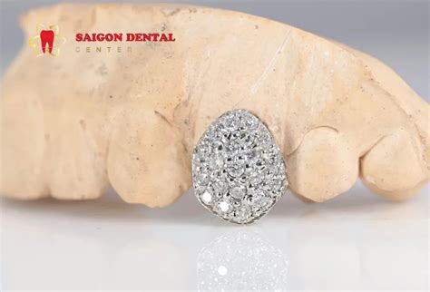 All About Diamond Teeth: Advantage - Procedure - Before After Image ...