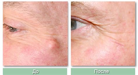 Удаление липомы лазером - обзор операции, эффективность ...