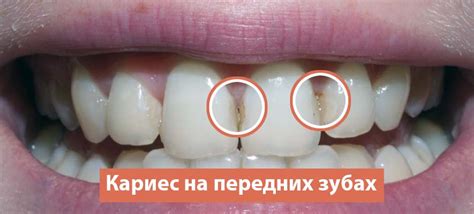 Лечение кариеса | Всё про кариес: виды кариеса, методы лечения, выбор ...