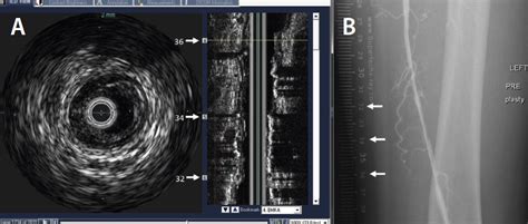 Optimizing Technique For Success A Guide For The Use Of Ivus In