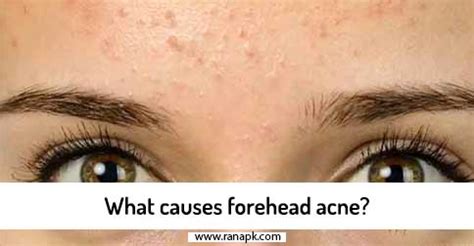 What causes forehead acne