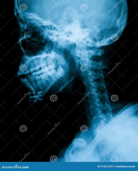 Skull X-ray Lateral View Fusion With MRI Brain Sagittal View. Royalty