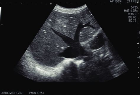 The Dilatation Of The Inferior Vena Cava And The Hepatic Veins