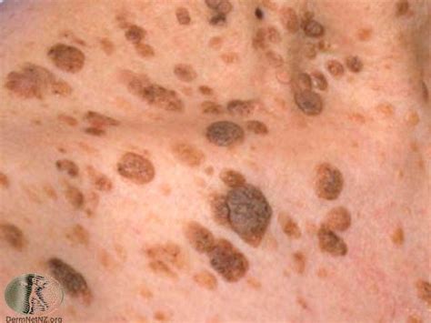 Flesh Colored Seborrheic Keratosis Infoupdate Org