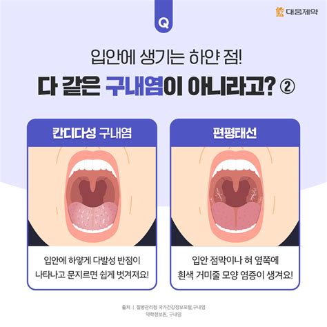 입안에 불 나는 입병 Aka 구내염 빨리 낫고 싶다면 ‘이것 도움돼 대웅제약 뉴스룸