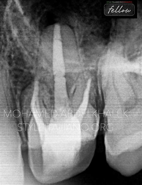 Re Treatment Decoding Obturation Dilemma Style Italiano Endodontics