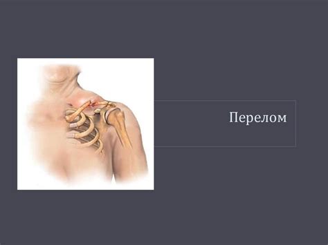Переломы. Вывихи - презентация онлайн