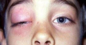 Some Steps to Practice Periorbital Cellulitis Treatment