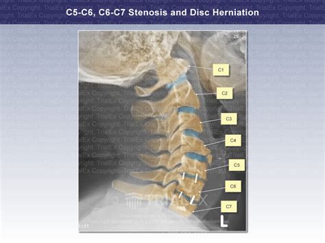 C5 C6 C6 C7 Stenosis And Disc Herniation Lateral View With Neck