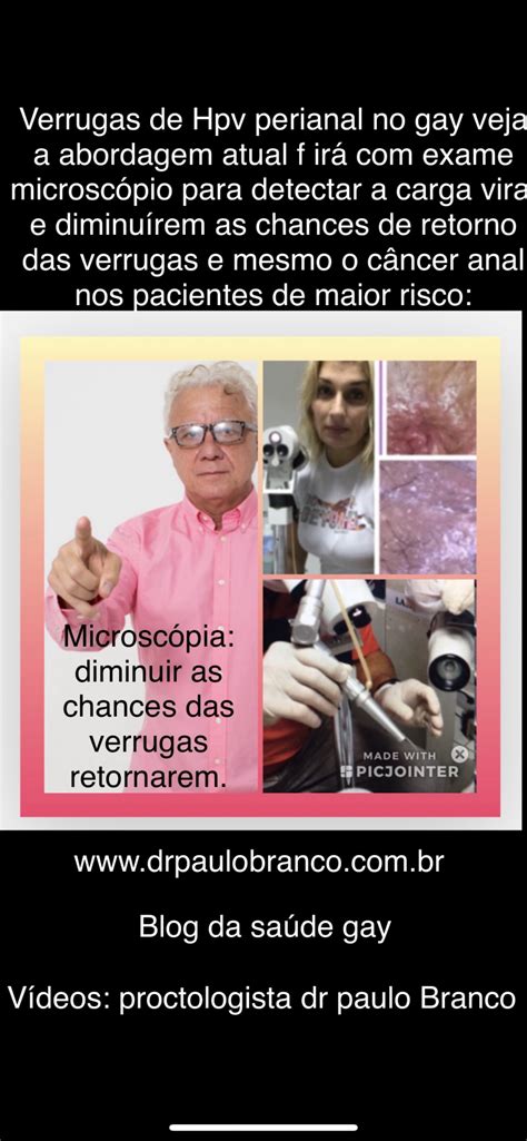 Caf No Tratamento Das Verrugas De Hpv Anal Dr Paulo Branco