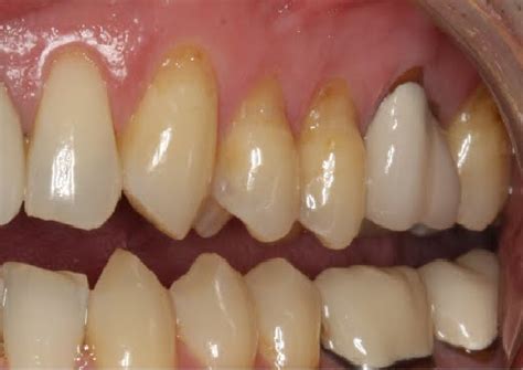 Self Loveself Careinspiration Tooth Abrasion