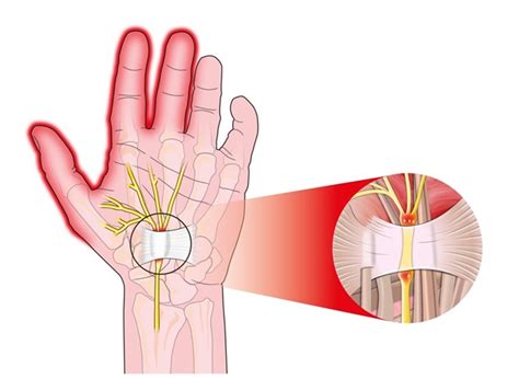 Carpaal Tunnel Syndroom HandsOnCare Klinieken