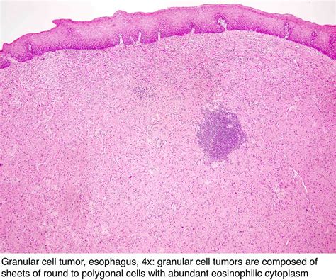 Pathology Outlines Granular Cell Tumor