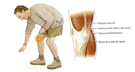 Prevenci N Y Tratamiento De La Tendinitis En La Pata De Ganso Al Fisio