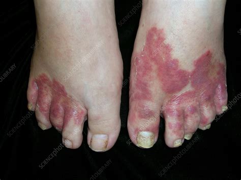 Athlete's foot - Stock Image - C056/5273 - Science Photo Library