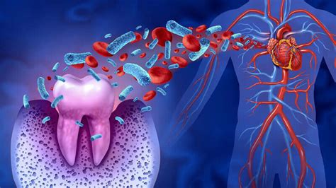 Periodontite E Arritmia Card Aca Uma Rela O Perigosa Dentalis