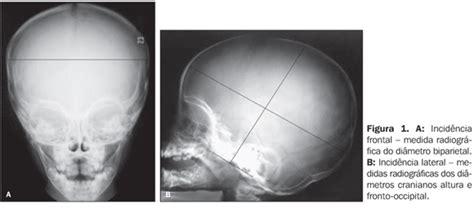 O Que Pode Nos Informar O Tamanho De Um Crânio - Brasil - Determinação radiológica do índice e do tamanho craniano por ...