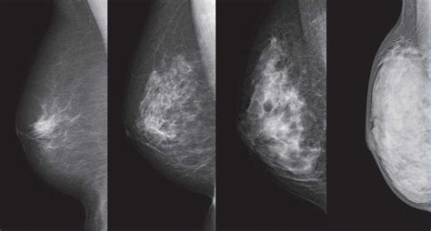 Cancer And Breast Density What Are Doctors Withholding The Japan Times