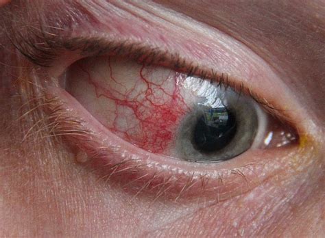Episcleritis Steve Lyhne Optometrists