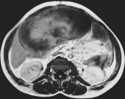 Mri Features Of Mesenteric Desmoid Tumors In Familial Adenomatous