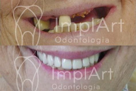 reabilitacao oral total resina idoso 50kb Implantes Dentários e