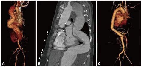 Preoperative And Postoperative Computed Tomography Ct Angiogram Of Download Scientific