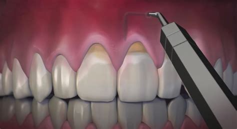 Pinhole Surgical Technique Pst™ Arkansas Periodontal And Implant