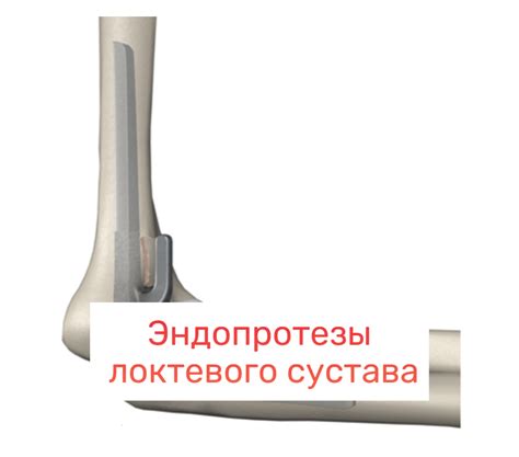 Эндопротез локтевого сустава: виды, производители, какой лучше