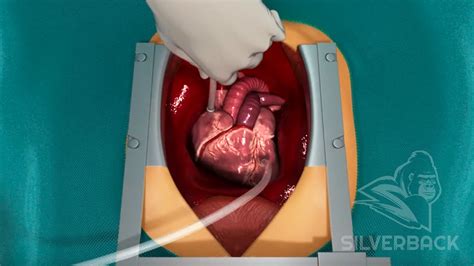 Cardiovascular Heart Bypass Surgery Procedure Youtube