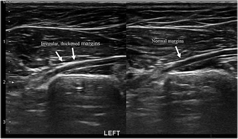 Frontiers Ultrasonography Findings In The Proximal Sciatic Nerve And